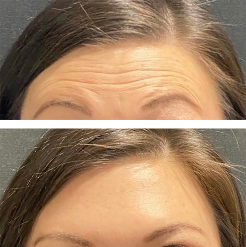 Botox Before & After Photo