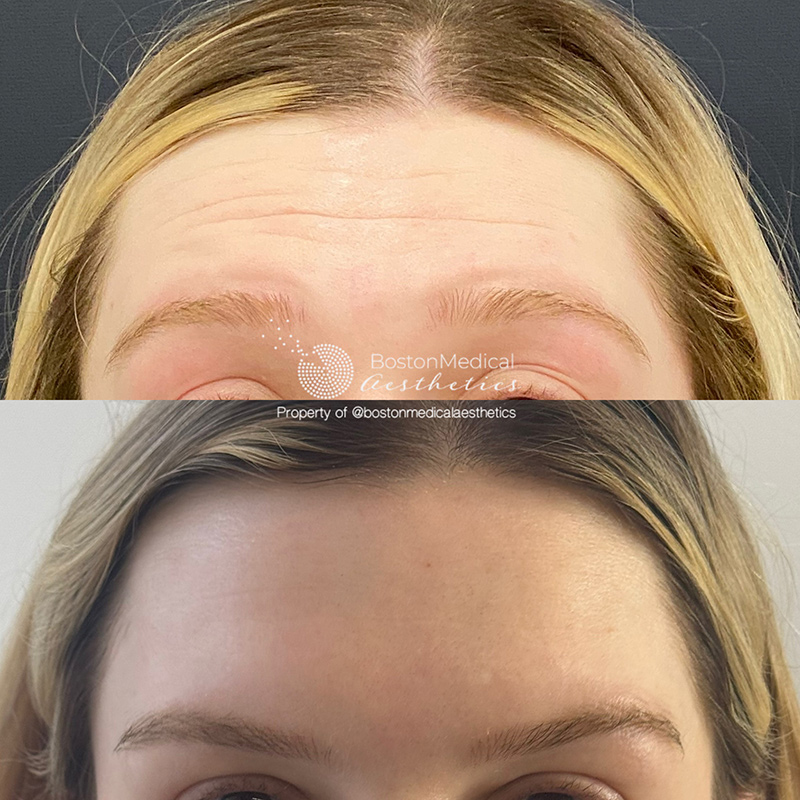 Botox and Dysport Before & After Photo