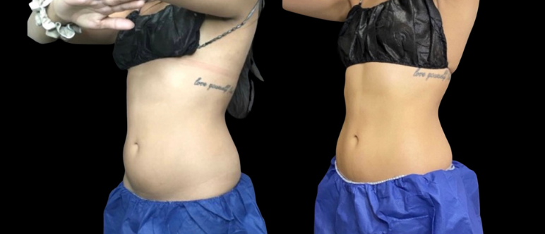 CoolSculpting® Elite Before & After Photos Patient 105, Boston, MA