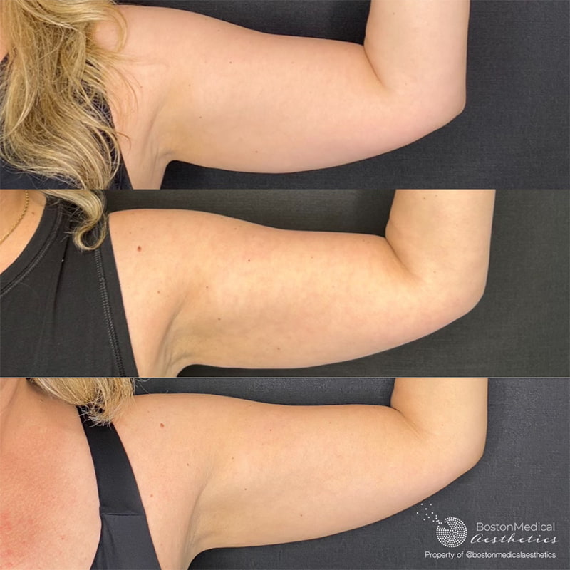 CoolSculpting Elite Before & After Photo