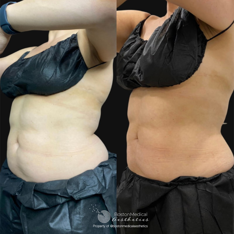 CoolSculpting Elite Before & After Photo