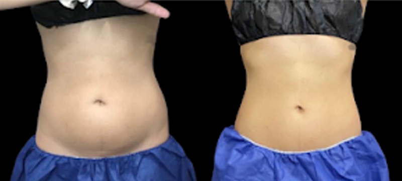 CoolSculpting Before & After Photo