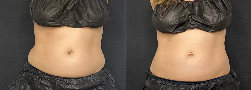 CoolSculpting Before & After Photo