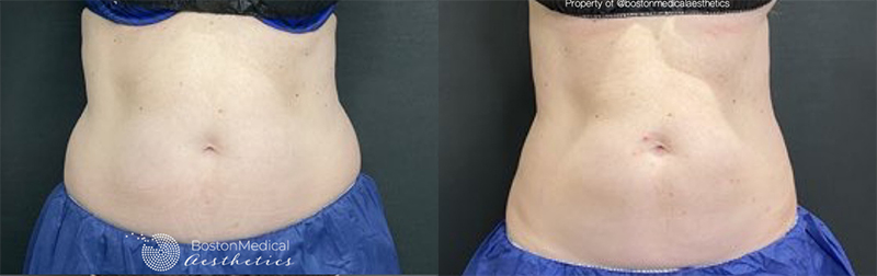 CoolSculpting Before & After Photo