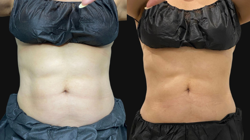 CoolSculpting Before & After Photo