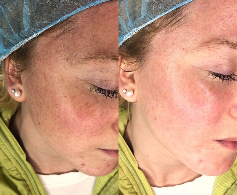 Dermaplaning Before & After Photo