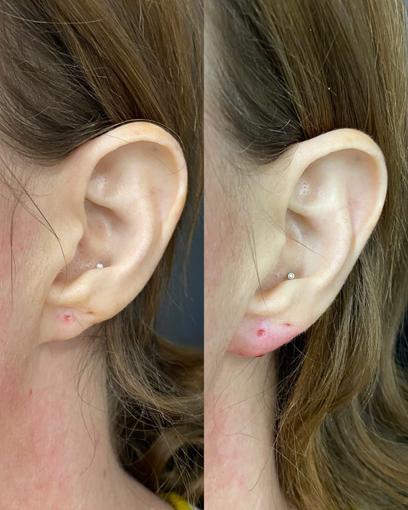 Earlobe Filler Before & After Photo