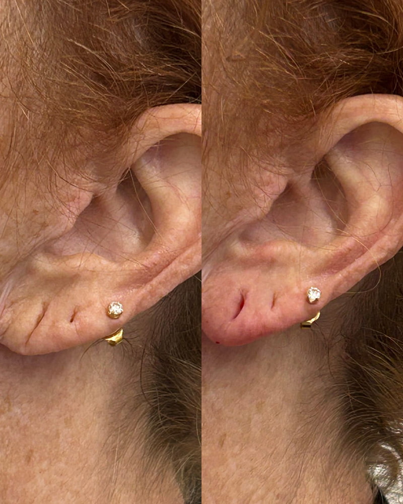 Earlobe Filler Before & After Photo