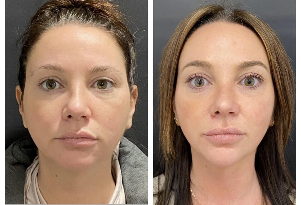 Facial Balancing Before & After Photo