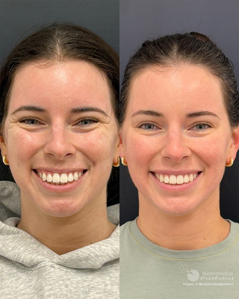 Facial Balancing Before & After Photo