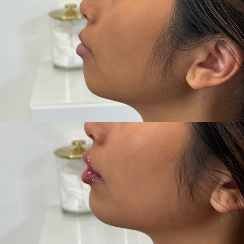 Facial Balancing Before & After Photo