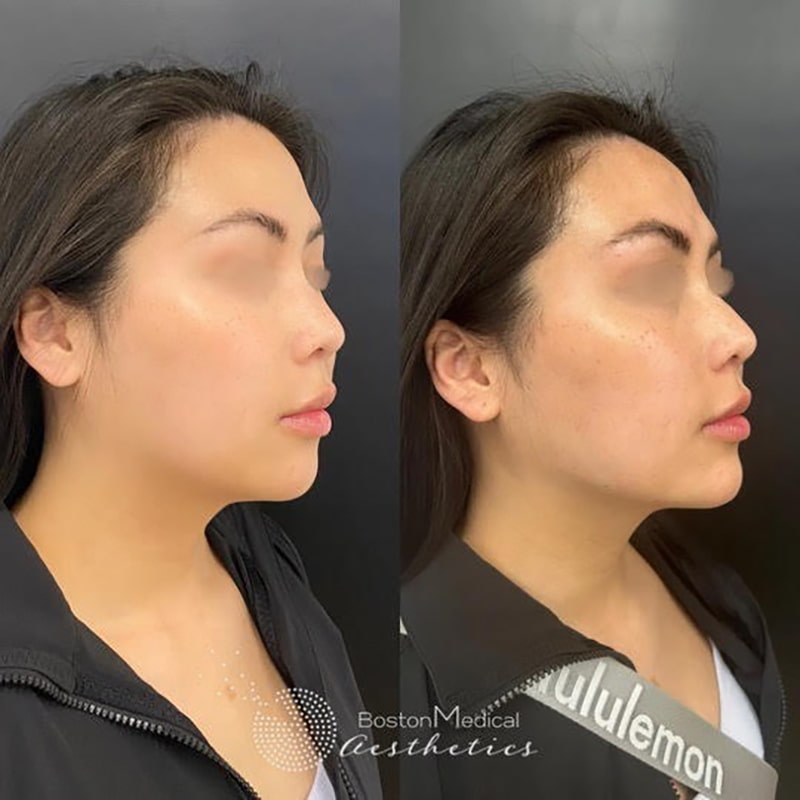 Facial Balancing Before & After Photo