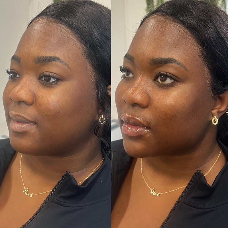 Facial Balancing Before & After Photo