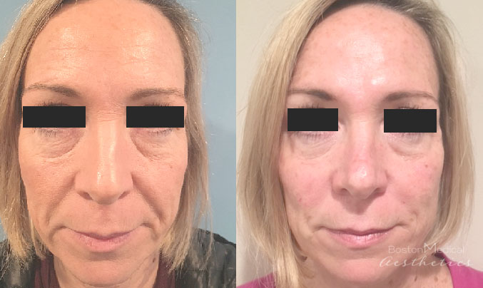 Juvederm In Boston Cosmetic Injectables Boston Medical Aesthetics