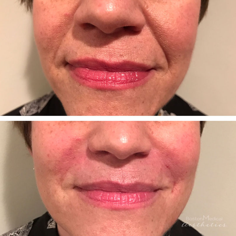 Facial Fillers Before & After Photo