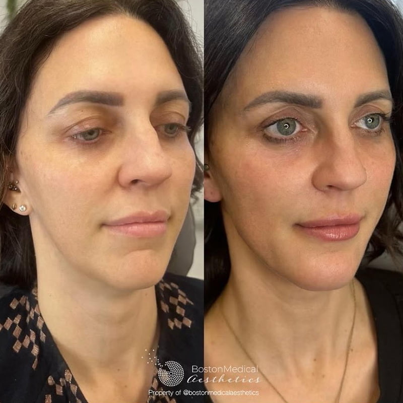 Facial Fillers Before & After Photo