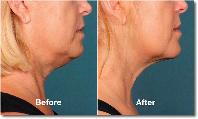 Kybella Before & After Photo