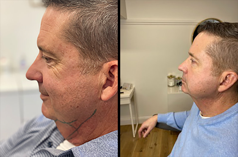 Kybella Before & After Photo