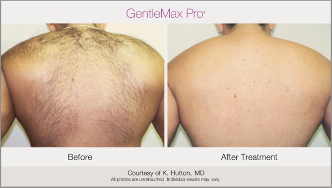 Laser Hair Removal Before & After Photo