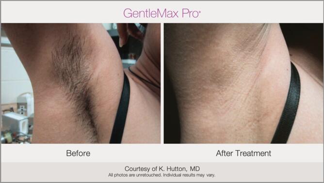 Laser Hair Removal Before & After Photo