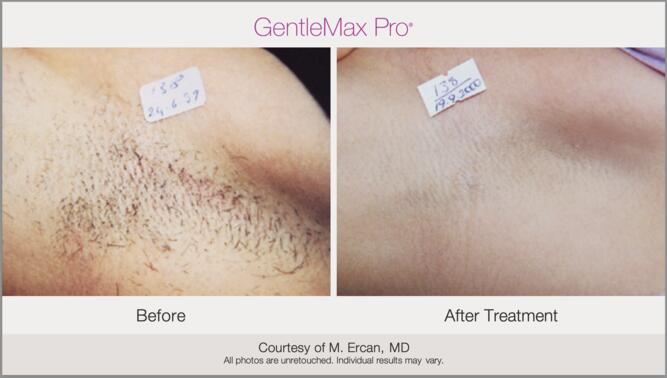 Laser Hair Removal Before & After Photo