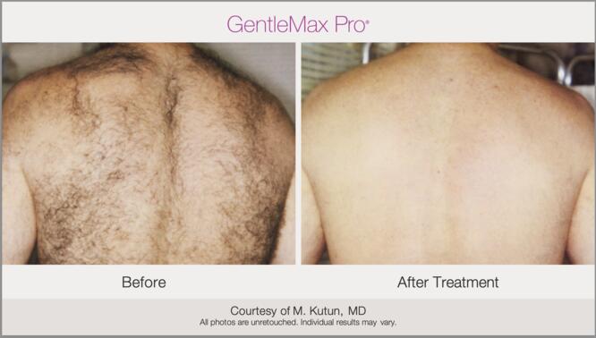 Laser Hair Removal Before & After Photo