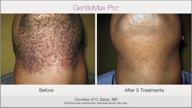 Laser Hair Removal Before & After Photo