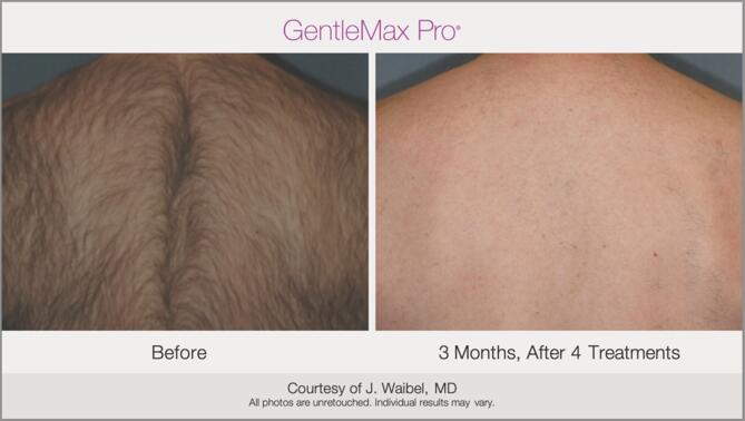 Laser Hair Removal Before & After Photo