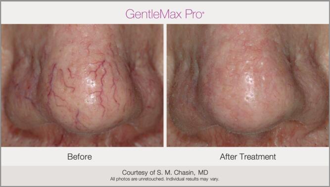 Laser Vessel Treatment Before & After Photo