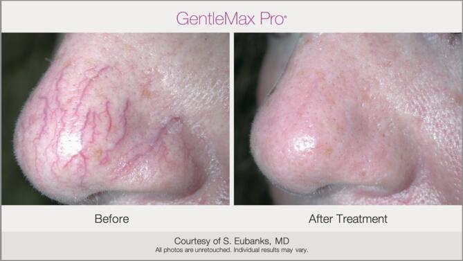 Laser Vessel Treatment Before & After Photo