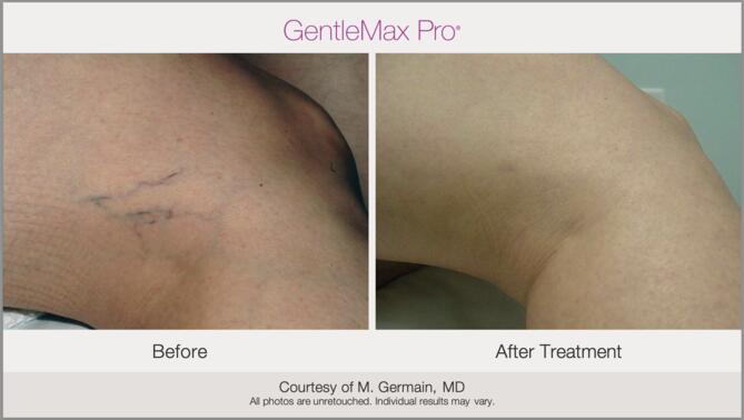 Laser Vessel Treatment Before & After Photo