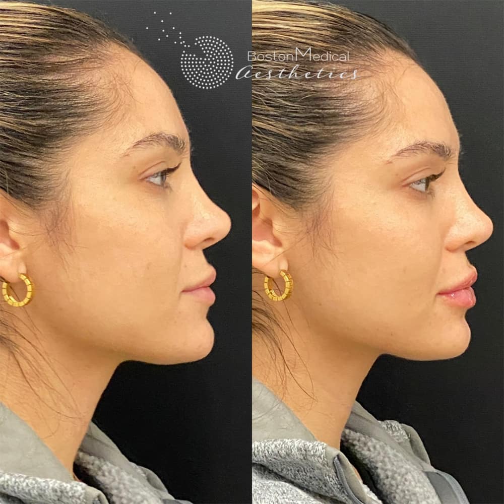 Lip Fillers Before & After Photo