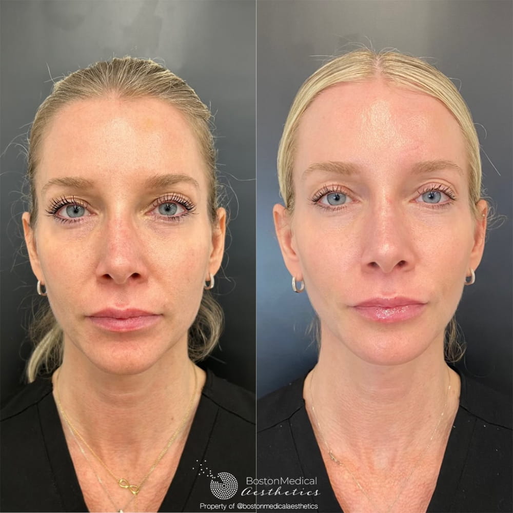 Lip Fillers Before & After Photo