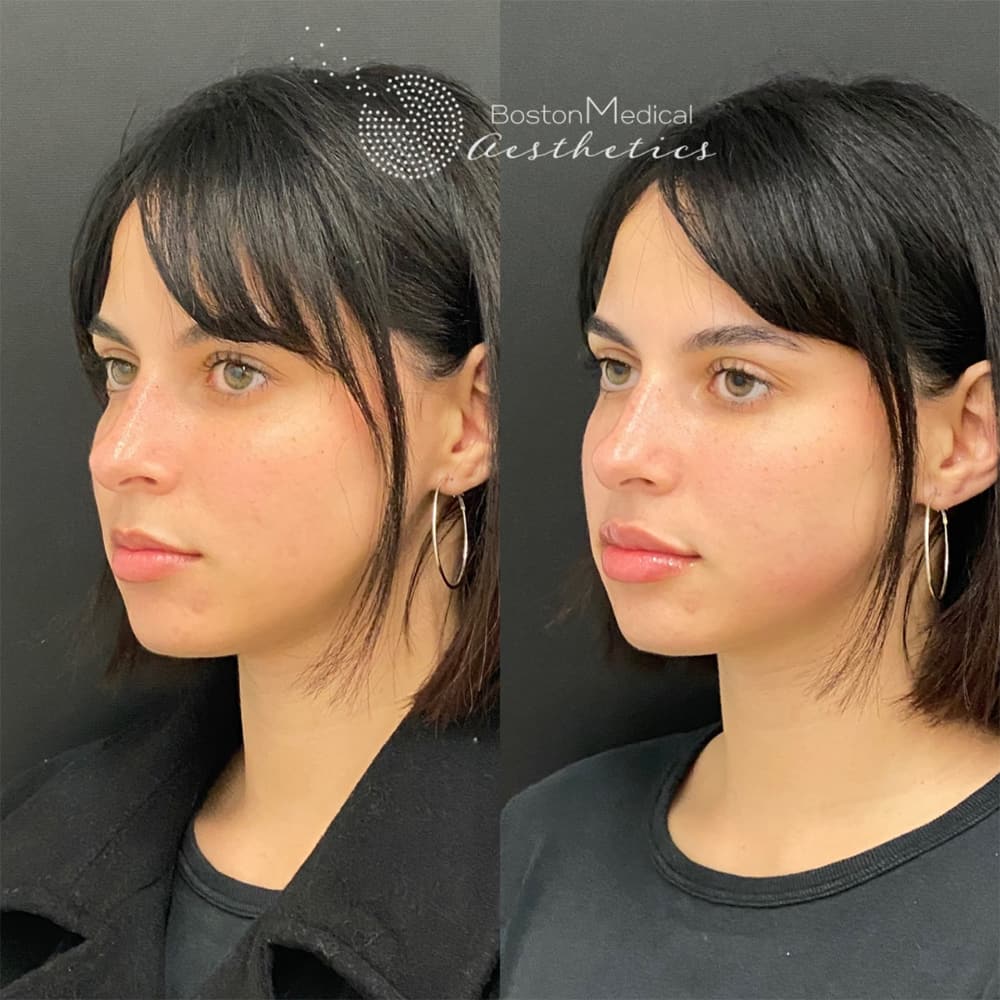 Lip Fillers Before & After Photo