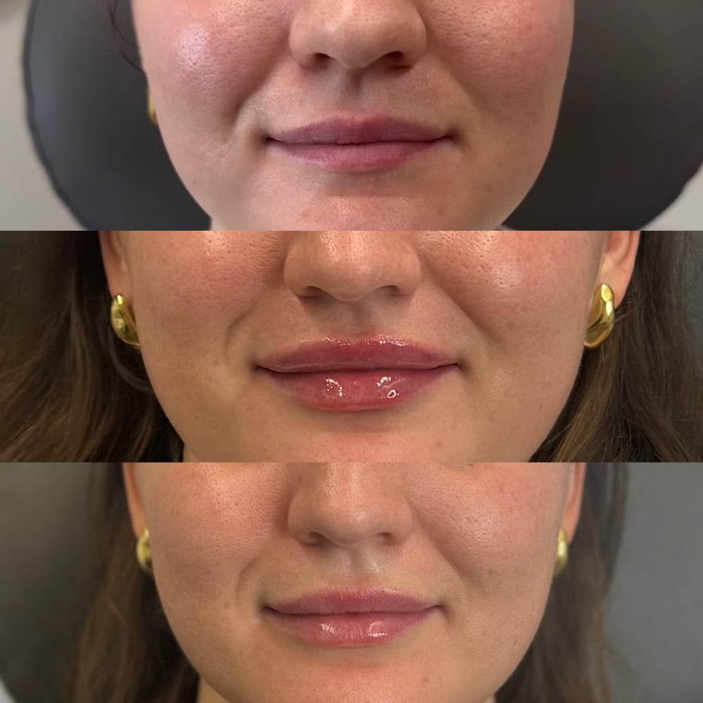 Lip Fillers Before & After Photo