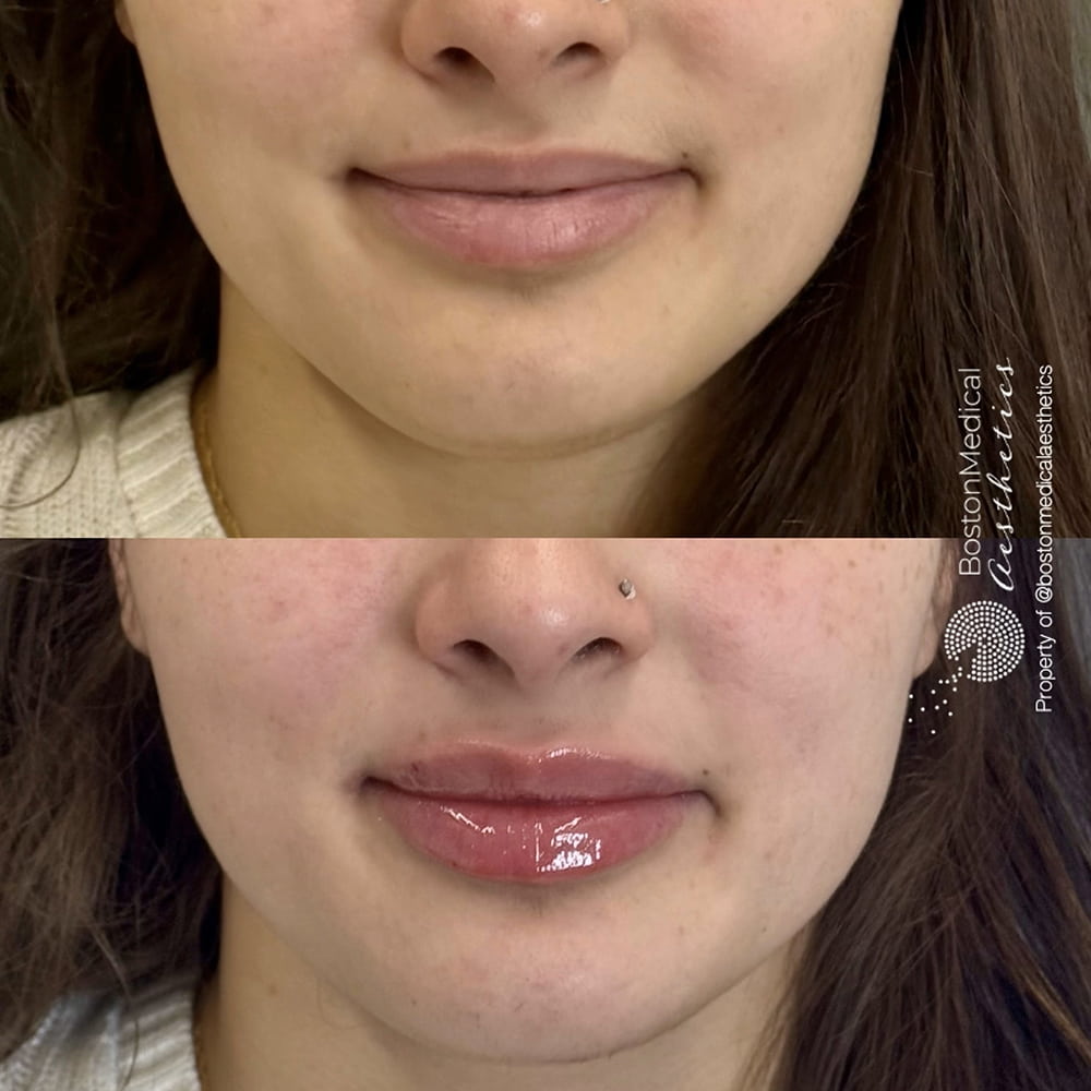 Lip Fillers Before & After Photo