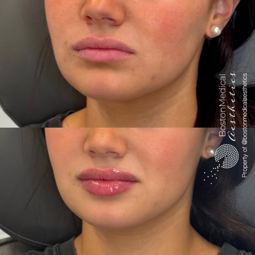 Lip Fillers Before & After Photo