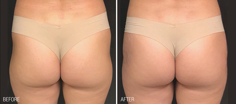 Liquid Butt Lift Before & After Photo