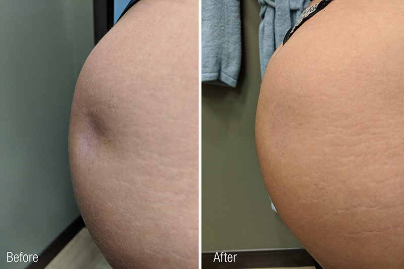 Liquid Butt Lift Before & After Photo