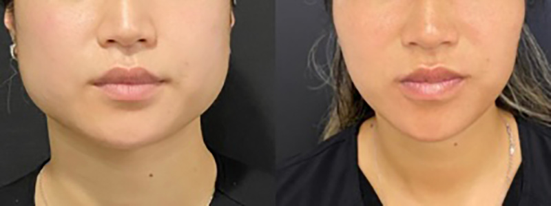 Masseter Before & After Photo