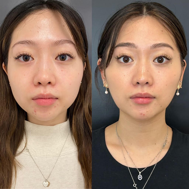 Masseter Before & After Photo