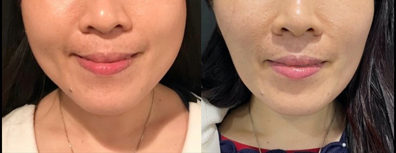 Masseter Before & After Photo