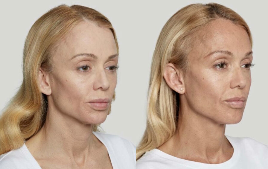 Sculptra Before & After Case 01 | Boston Medical Aesthetics