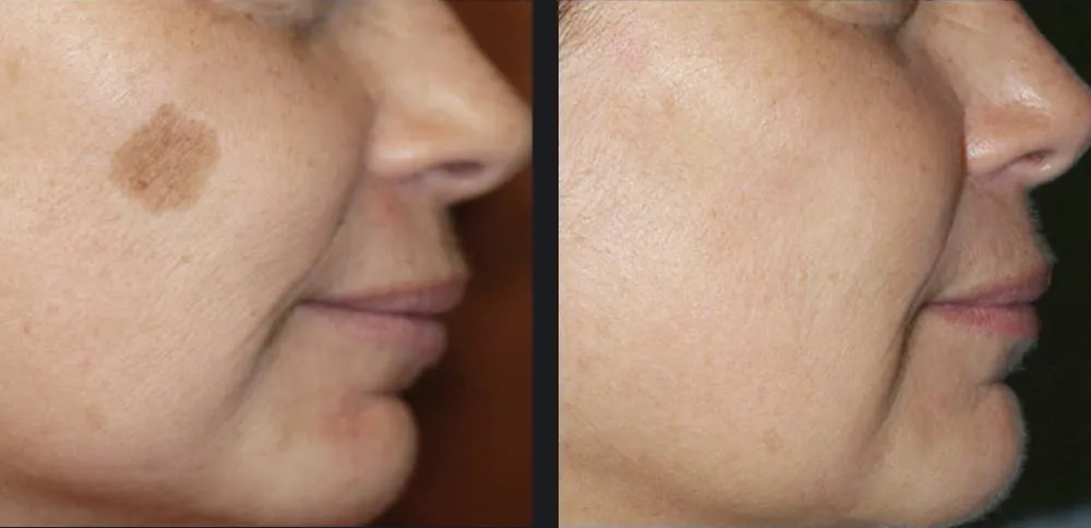 Skin Pigmentation Before & After Photo