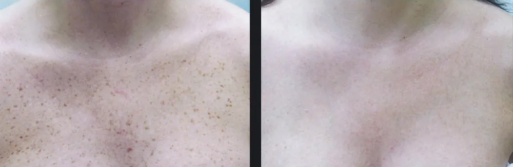 Skin Pigmentation Before & After Photo