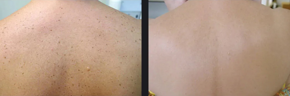 Skin Pigmentation Before & After Photo