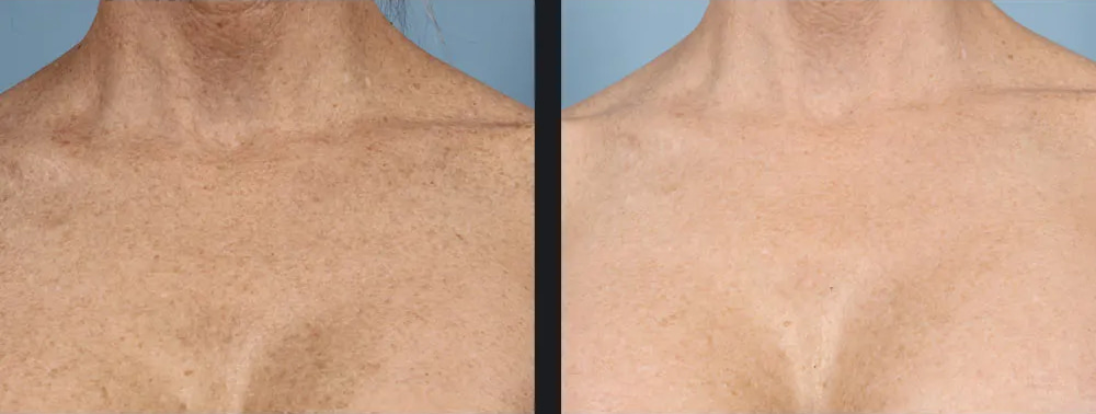 Skin Pigmentation Before & After Photo