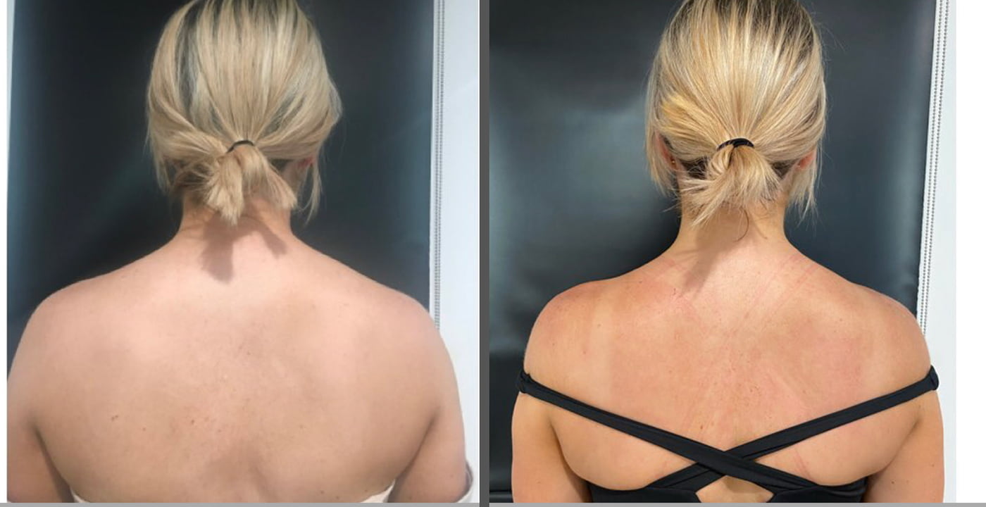 Trapezius Botox: How It Works, Before and Afters